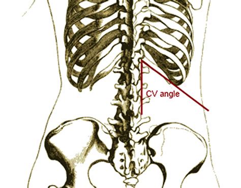 Costovertebral angle definition, costovertebral angle tenderness test