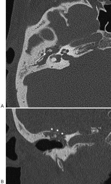 CT images of a 15-year-old patient with cholesteatoma. On axial image ...