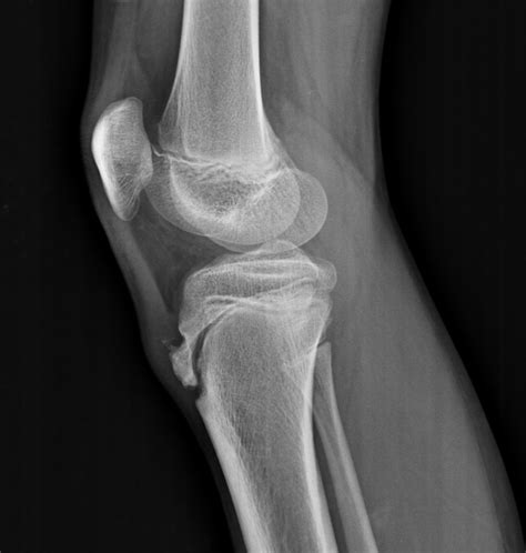Osgood-Schlatter disease | The Third Eye - Radiology site