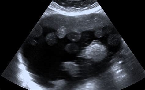 Cystic Teratoma Ultrasound