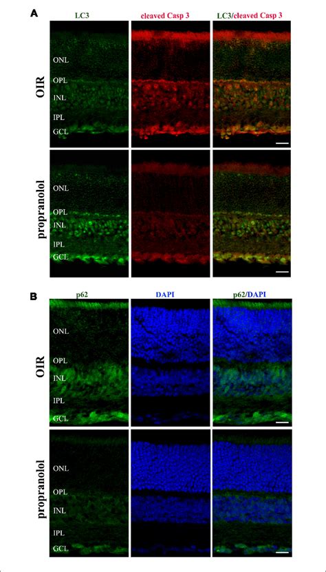 Propranolol Effects On The Expression Pattern Of Apoptosis And