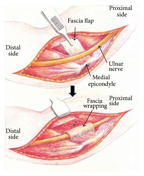 Anterior Transposition Of The Ulnar Nerve Ulnar Nerve Compression Hot