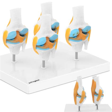 3D Anatomical Model Of The Knee Joint With Lesions 4 Changes 1 2 Scale