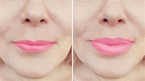 Preenchimento Labial 2 Ml Antes E Depois Veja Os Benefícios