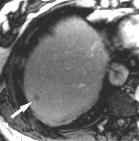 Using Superparamagnetic Iron Oxide Enhanced Mri To Differentiate