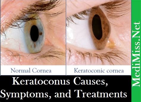 Keratoconus Causes Symptoms And Treatments Skinnyzine