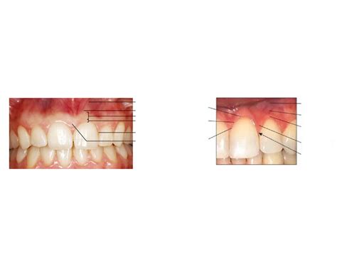 Macroscopic gingiva anatomy Quiz