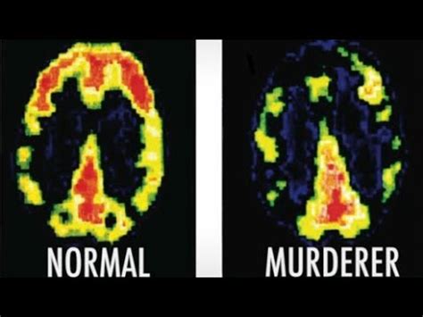 Cómo es el cerebro de un psicópata asesino u otros criminales