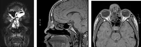 Nasal Dermoid Cyst Excision With A Lateral Rhinotomy Approach Through