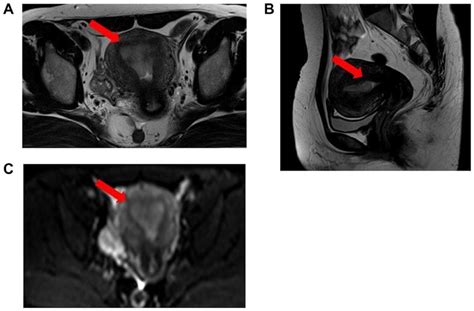 Mri Findings A Axial T2 Weighted Image T2w1 B Sagittal