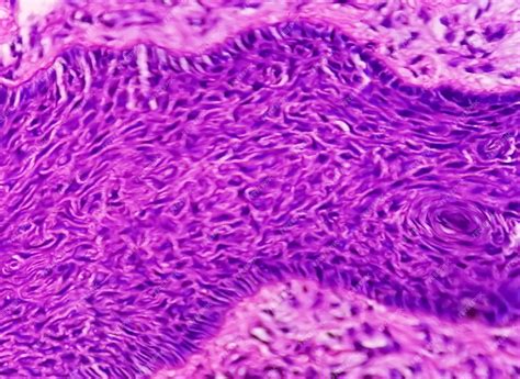 Biópsia De Pele Sob Microscopia Sugestiva De Carcinoma Basocelular O