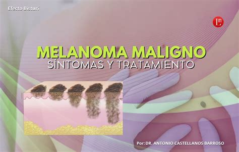 Melanoma Maligno SÍntomas Y Tratamiento Latitud Megalópolis