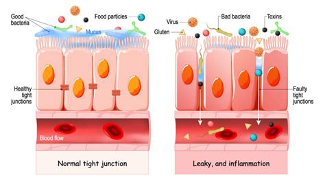 Leaky Gut Syndrome - Dr. Todd Maderis