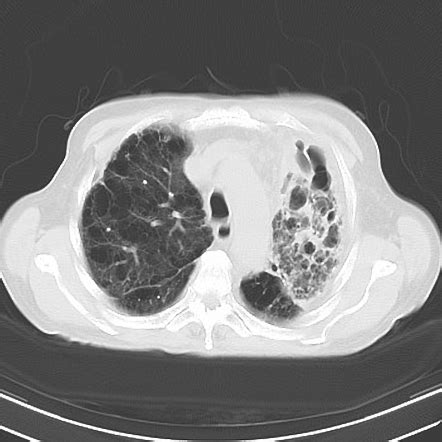 Combined Pulmonary Fibrosis And Emphysema Image Radiopaedia Org