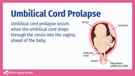 Umbilical Cord Prolapse - Birth Injury Guide