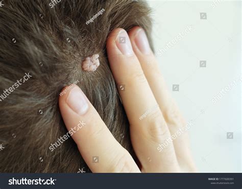 Sebaceous Nevi Royalty Free Images Stock Photos Pictures Shutterstock