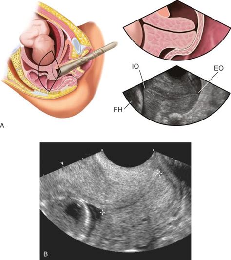 Ultrasound Evaluation Of The Gravid Cervix Clinical Tree