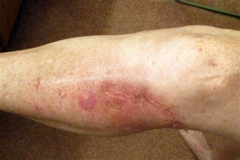 Jayaruh's Blog: Leg Infection