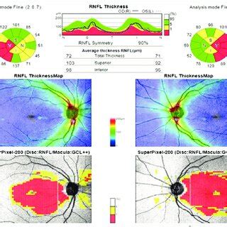 Optical Coherence Tomography Shows Thinning Of Retinal Nerve Fiber