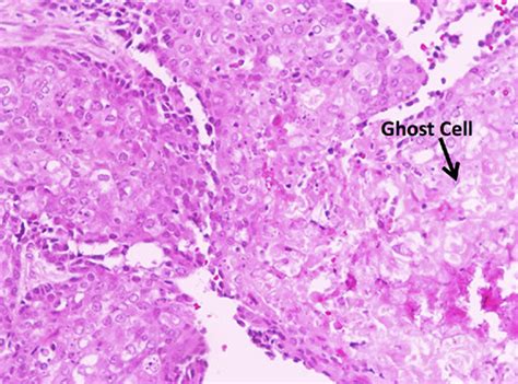 ghost cells  oral pathology