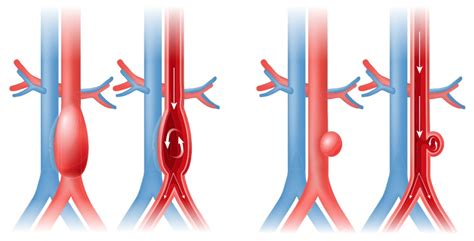 Aaa Abdominal Aortic Aneurysm