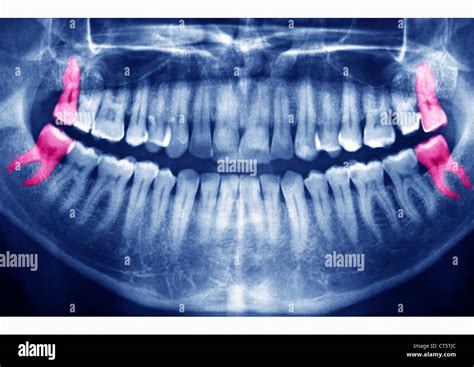 Wisdom Teeth X Ray Hi Res Stock Photography And Images Alamy