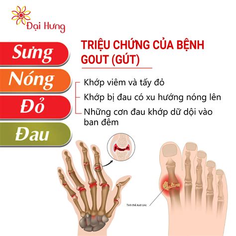 Triệu Chứng Bệnh Gout và Cách Điều Trị Hiệu Quả Từ A Z