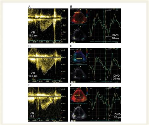 Measurements Of Pulsed Wave Doppler Derived Left Ventricle Outflow Download Scientific Diagram