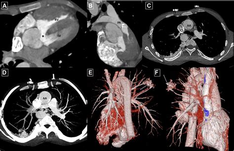 Pulmonary Arteriovenous Malformation In An Unrepaired Tetralogy Of