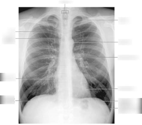 Lung X-ray Diagram | Quizlet