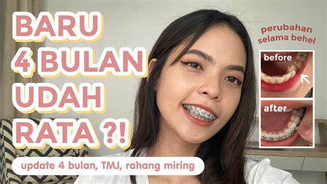 Perubahan Selama Pake Behel Tmj Rahang Miring Braces Journey Youtube