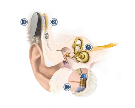 Implantierbare Hörgeräte