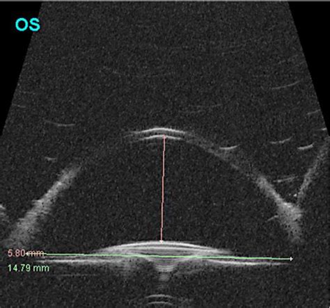 Figure 1 from Anterior Chamber Iris Claw Lens for the Treatment of ...