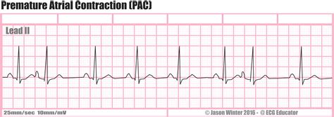 Ecg Educator Blog Premature Atrial Contraction Pac