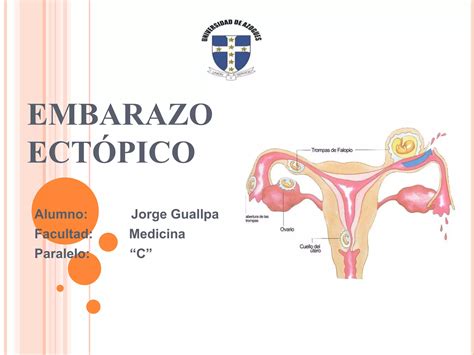 Embarazo Ectopico Ppt Descarga Gratuita