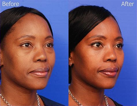 Results Gallery — Sky Facial Plastic Surgery