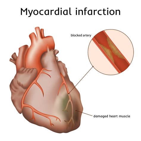 Myocardial Infarction The DADA2 Foundation