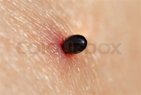 The Castor Bean Tick In Human Skin Stock Image Colourbox