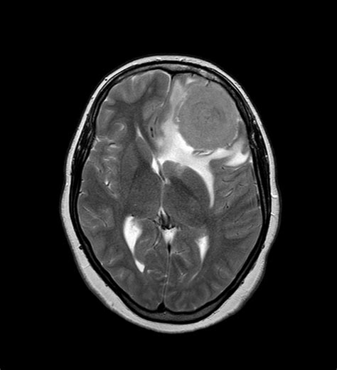 Meningothelial Meningioma Image Radiopaedia Org