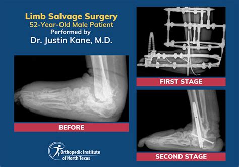 Limb Salvage Surgery In Frisco Tx Oint