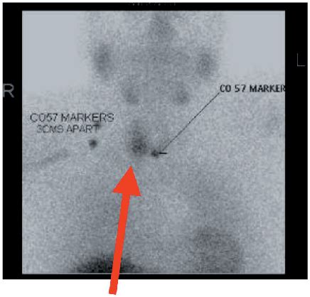 Sarcoid Granulomas In The Parathyroid Gland A Case Of Dual Pathology