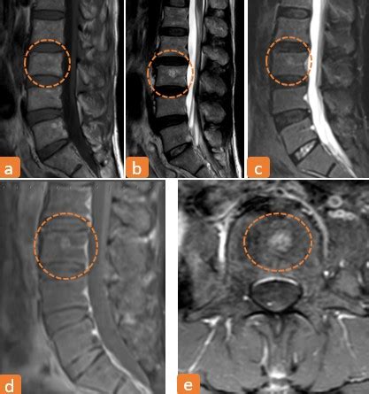 Lipid-Poor Vertebral Hemangioma mimicking a vertebral metastasis of cervical carcinoma - Authorea