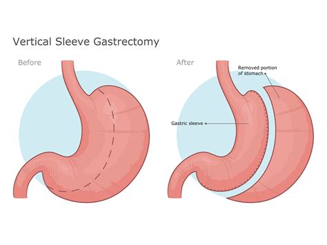 Gastric Sleeve Surgery The Benefits And Risks You Should Know About