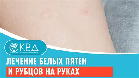 Лечение белых пятен и рубцов на руках. Клинический случай №800 - YouTube