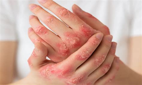 Apakah Psoriasis Berbahaya Kenali Jenis Gejala Penyebab Pengobatan