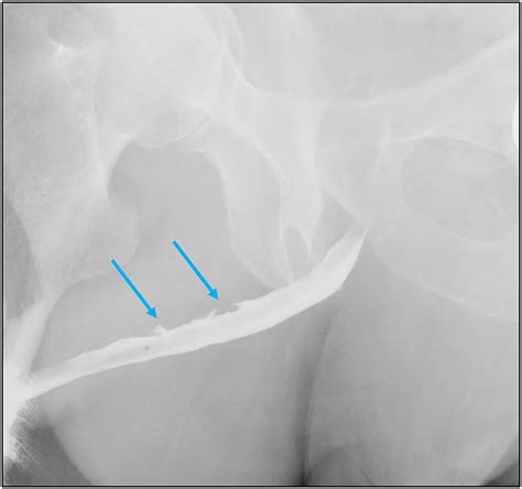 Anterior Urethral Strictures And Retrograde Urethrography An Update For Radiologists Clinical