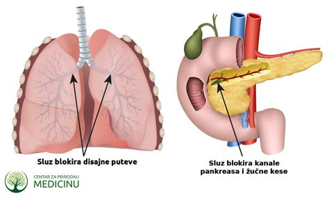 Cistična fibroza uzrok simptomi i lečenje prirodnim putem