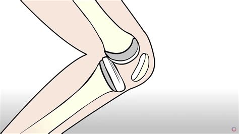 Regenexx Procedures For Knee Injuries And Arthritis Momenta Pain Care