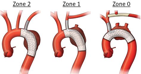 First Branch Of Aortic Arch Surgery