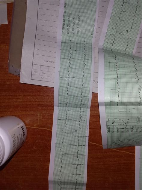 EKG in a patient with acute pulmonary edema. A possible previous heart ...